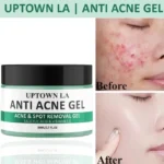 Uptown La acne scar removal exfoliating gel – standard size